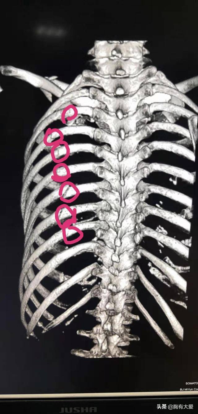 肋骨骨折是个坑 就看挖的深不深 诊断 胸部 患者