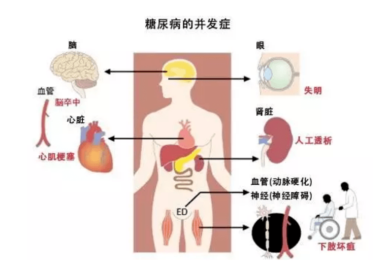 ⑥糖尿病神经病变⑤糖尿病性脑血管病④糖尿病心血管并发症③糖尿病足