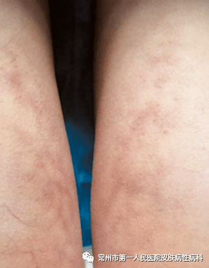 这些难看的网状红斑会消退吗?