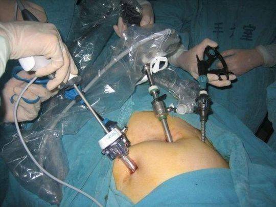 宫腹腔镜手术过程图片