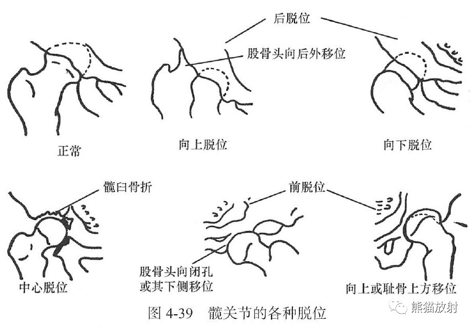 示意圖;b.股骨頸頭下骨折,左側股骨頸頭下部骨質連續中斷:c.