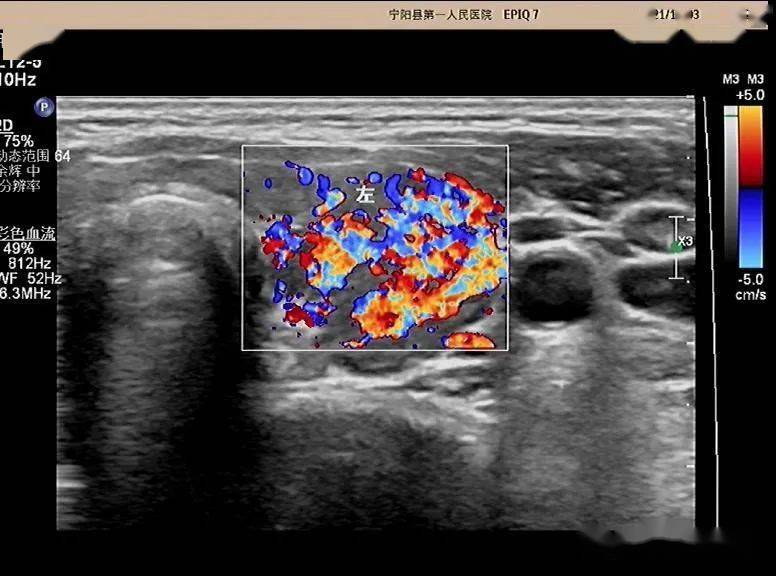 超声问答61这个颈部淋巴结应该如何考虑?