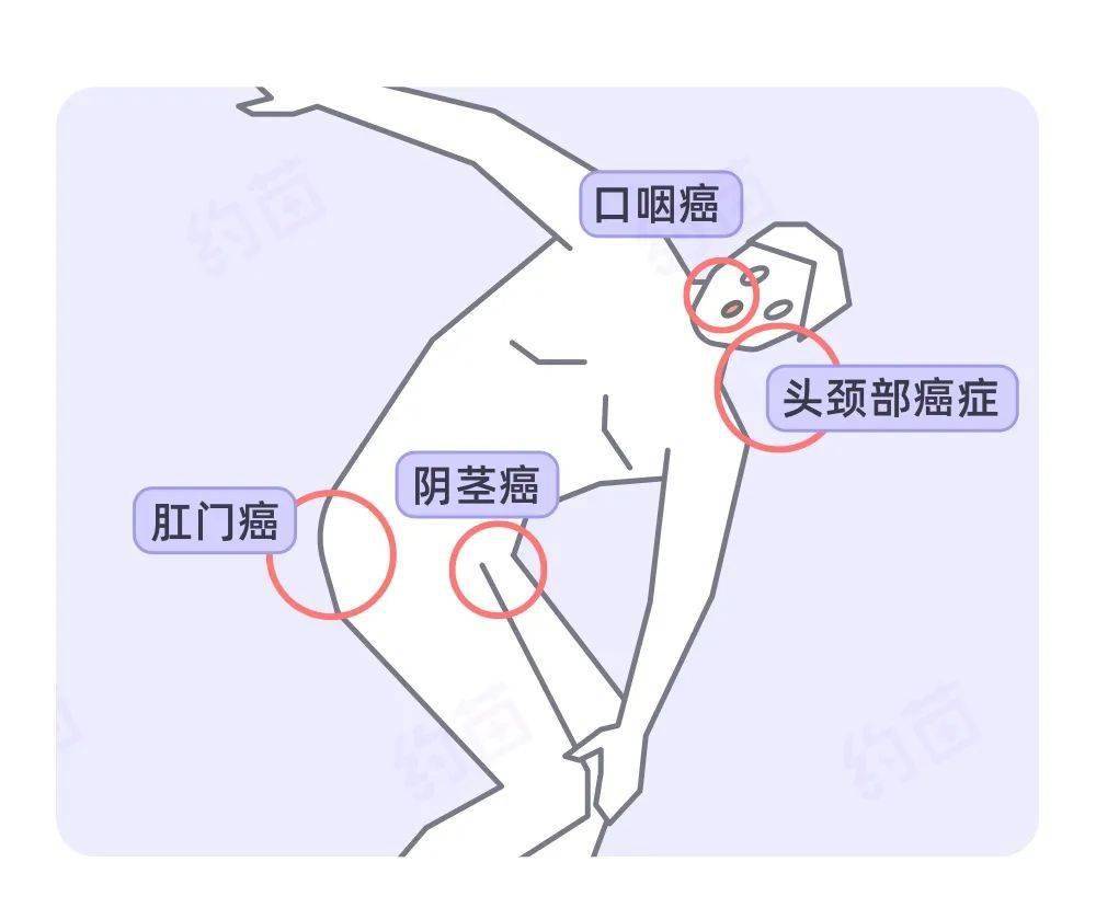 龟头癌早期症状图图片