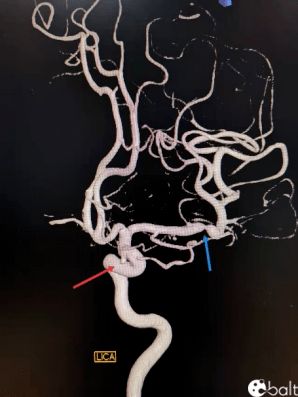 动脉瘤支架颅内动脉瘤图片