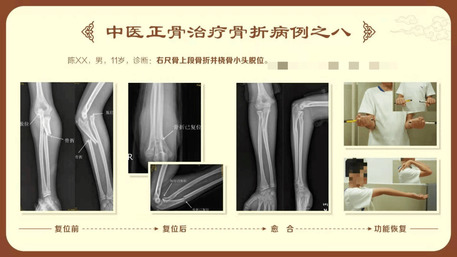 手術|骨折一定要開刀做手術？一文看懂中醫正骨有哪些神奇之處