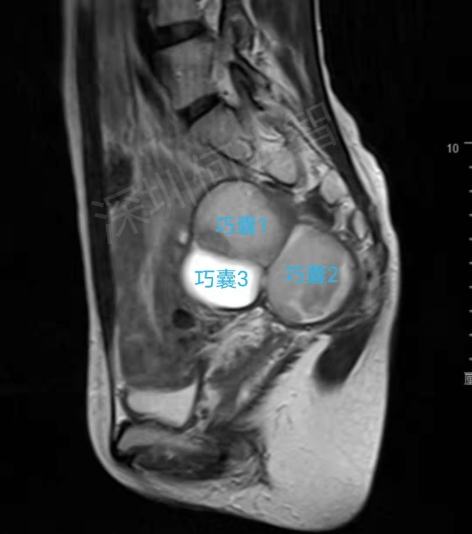 何光智|女子盆腔深部长多个巧克力囊肿，超声介入硬化治疗后囊肿消失