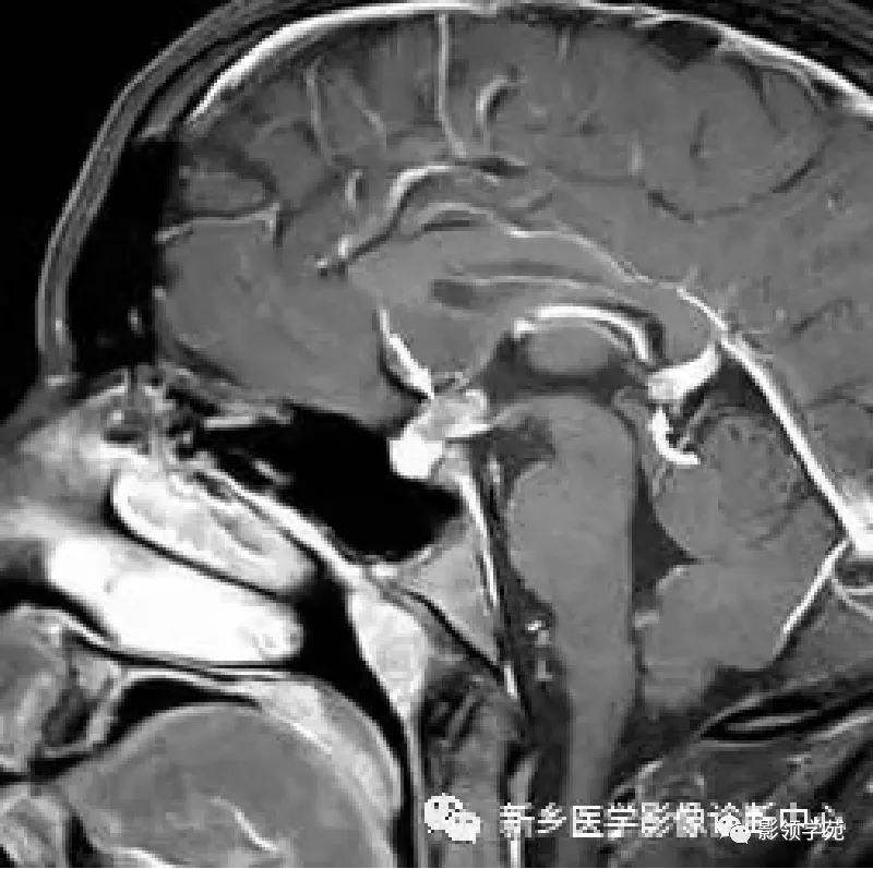 Rathke|垂体解剖及常见病变影像学表现