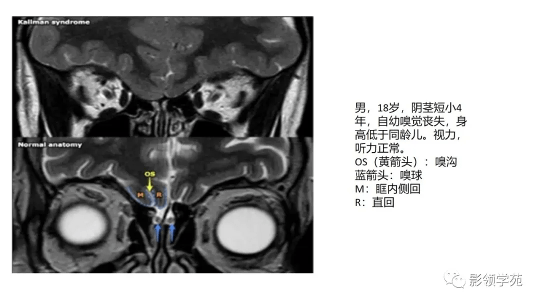 Rathke|垂体解剖及常见病变影像学表现