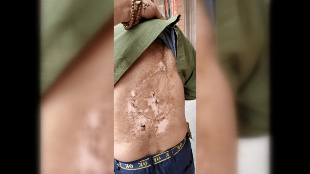 近30厘米,这道伤疤看着都疼!他却说……_谢荣华_林国文_志愿军