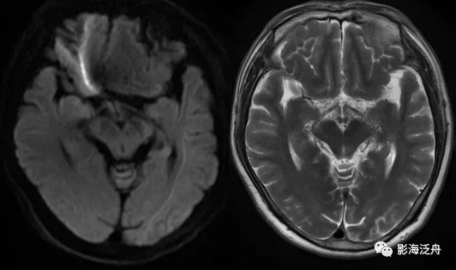 诊断|颅脑MR平扫中极易漏诊的点