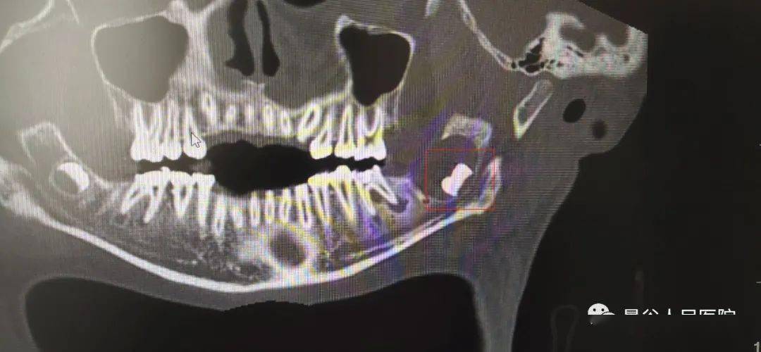 颌骨骨髓炎影像图片