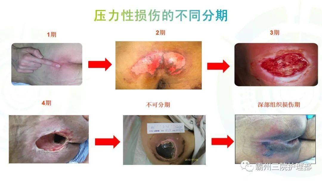 ppt压力性损伤的预防与护理