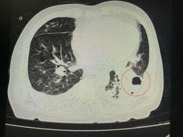 症状|“超低价”种了颗牙，结果住进ICU，肺部啃出无数个洞