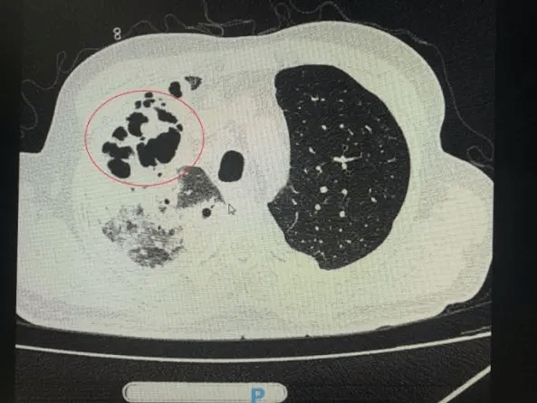 症状|“超低价”种了颗牙，结果住进ICU，肺部啃出无数个洞