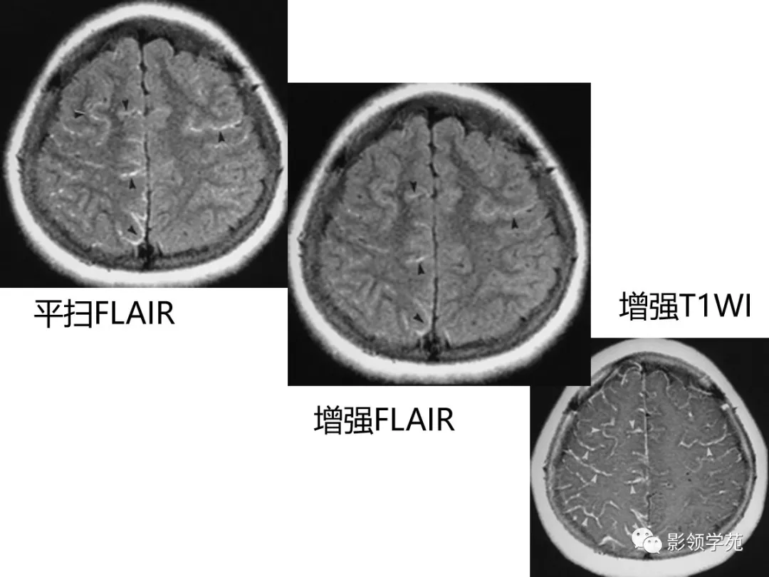 雖然無法與彌散成像(dwi)相比,但增強flair可在常規mri無發現時顯示