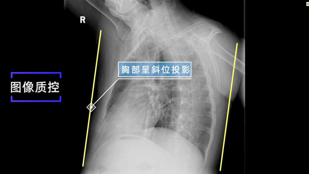 X线规范化检查 | 胸部左、右前斜位摄影（视频及图文详解）_影像_探测器_胸椎