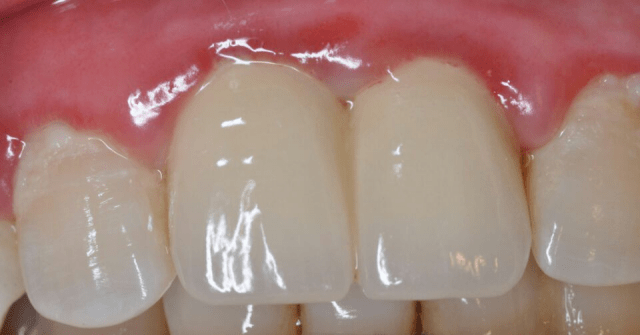 牙龈与修复体边缘关系图解