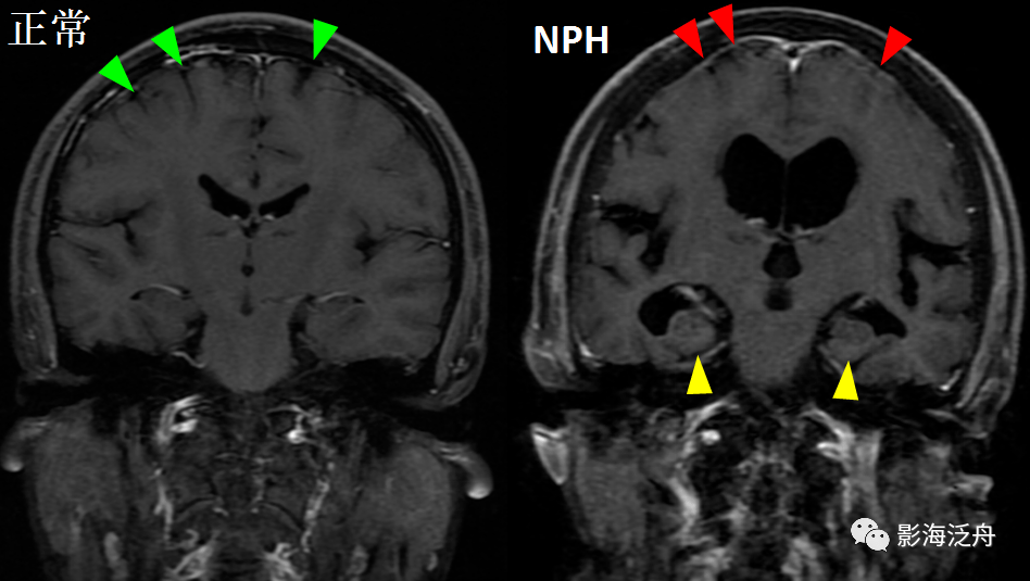 诊断|小心误诊，这可不是单纯的脑萎缩