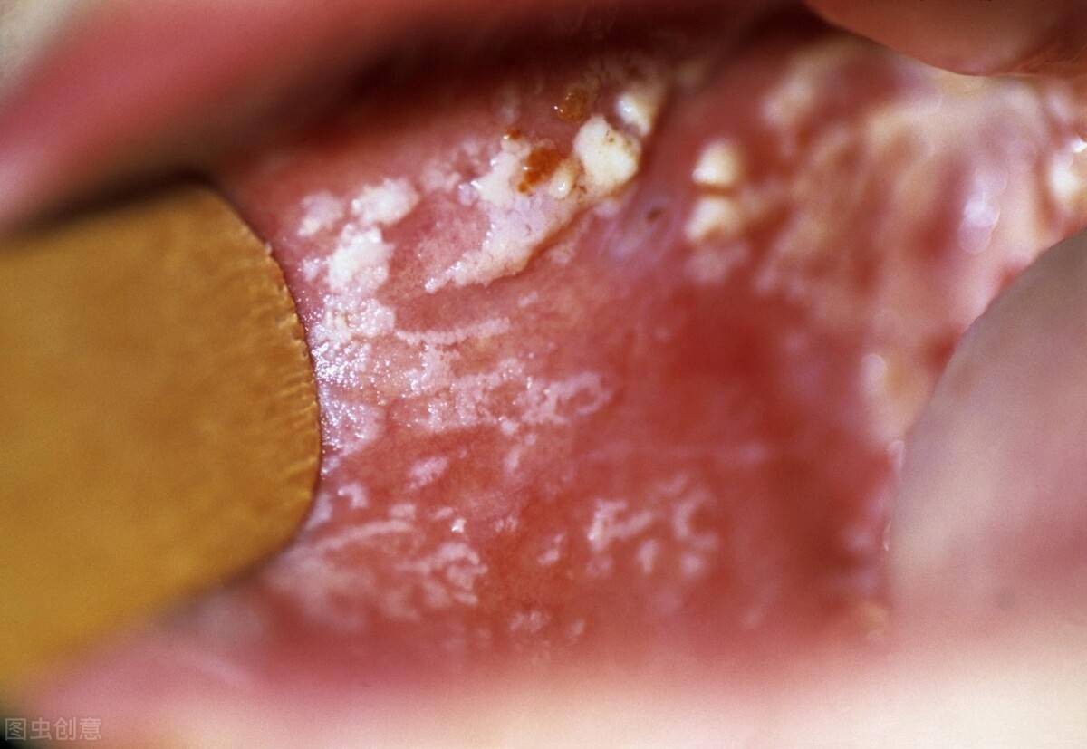 会感染常人不会感染的病原体,比如真菌,尤其是口咽部念珠菌感染,嘴巴