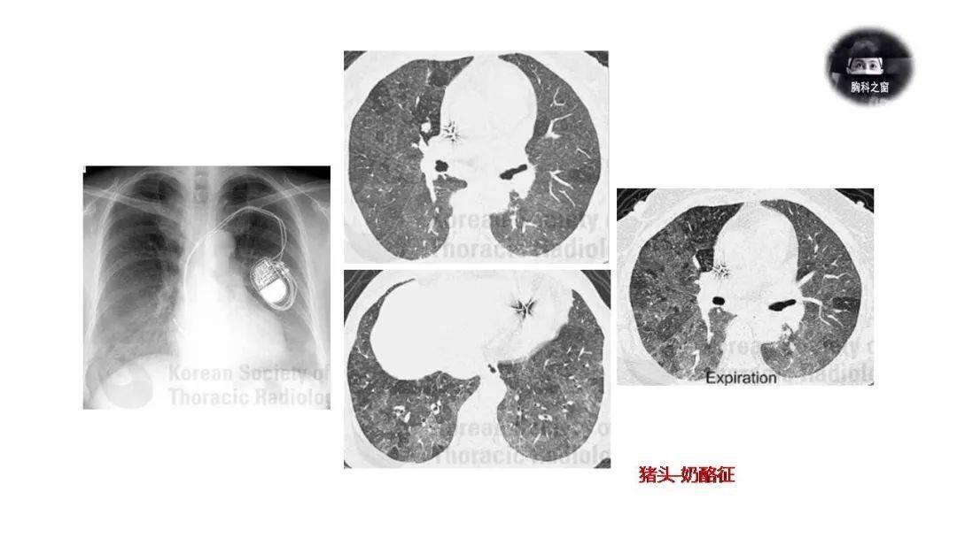 pap(肺泡蛋白沉著症):毛玻璃影伴光滑的小葉間隔增厚(即瘋狂鋪路石徵)