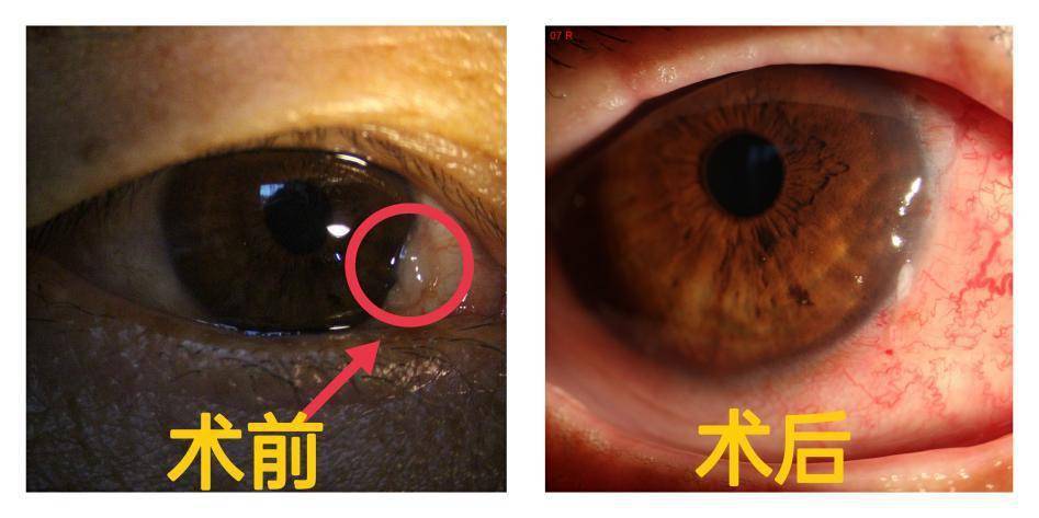 右眼|警惕眼内膜状物生长，眼科专家：胬肉除带来不适还很伤眼！