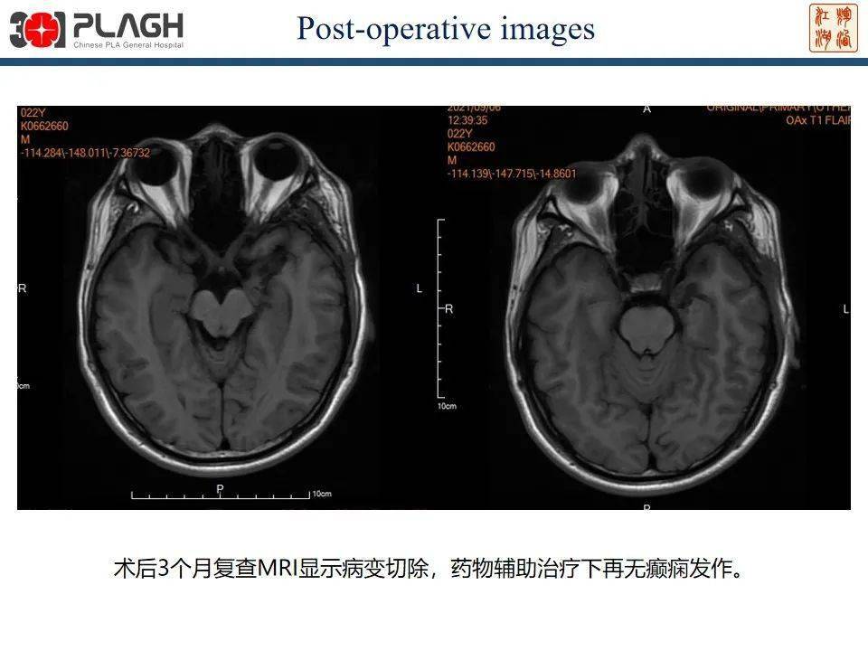 颞叶钩回图片