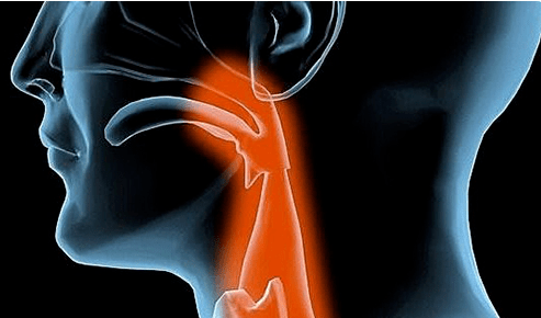 喉咙异物感、打嗝是食道癌的表现吗？