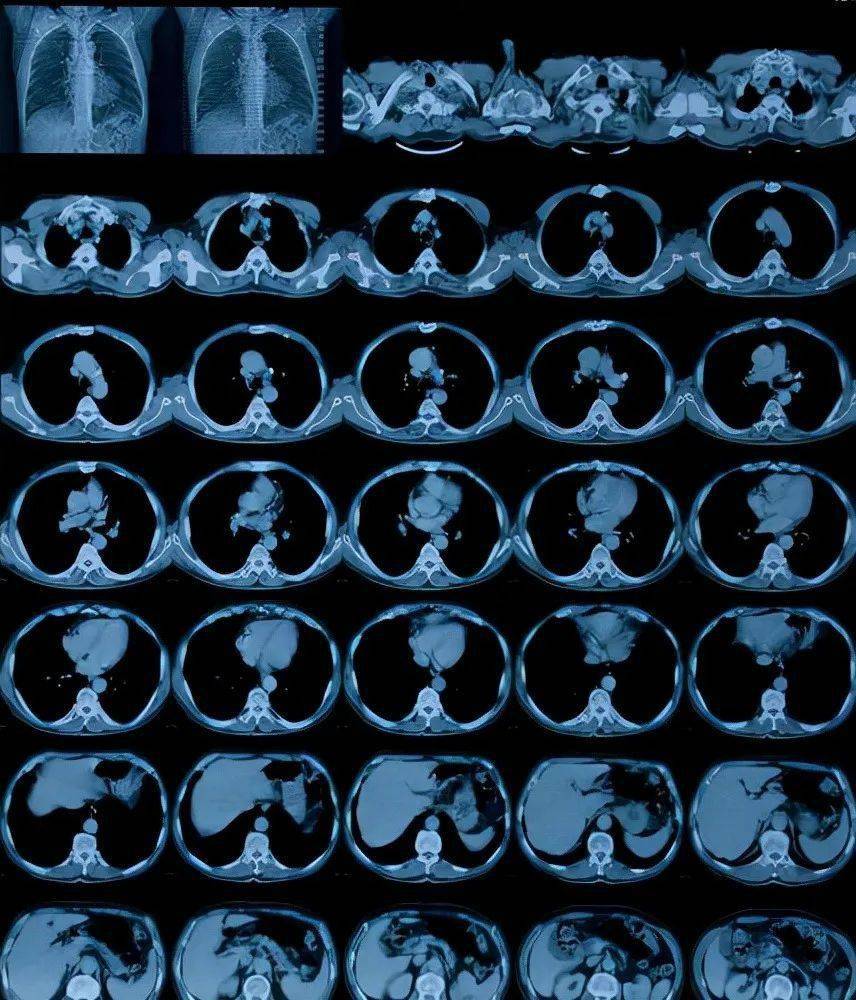 ct会致癌吗?快看医生怎么说!_癌症_诊断_部位