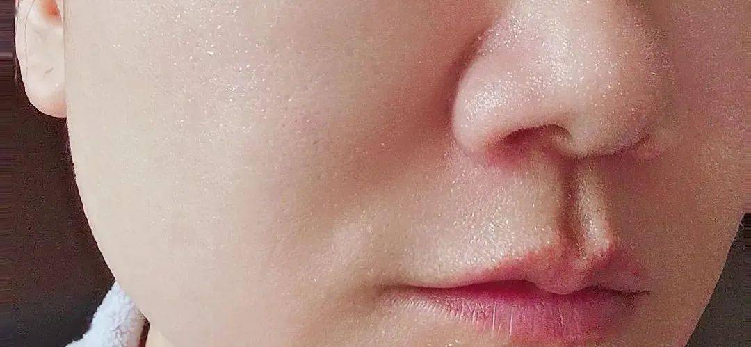 什么视频：陪伴我40多年的痣，几秒钟就没了。。。。