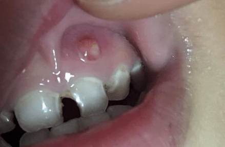 牙龈坏死症状图片图片
