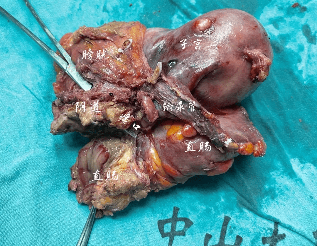 攻克又一難關多學科協作全盆腔臟器切除術為患者迎來新希望