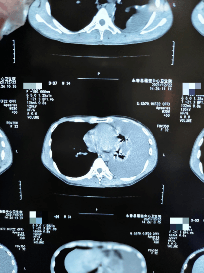 术前术后病理结果结合病史,影像学,结核感染t细胞检测,结核性胸膜炎可