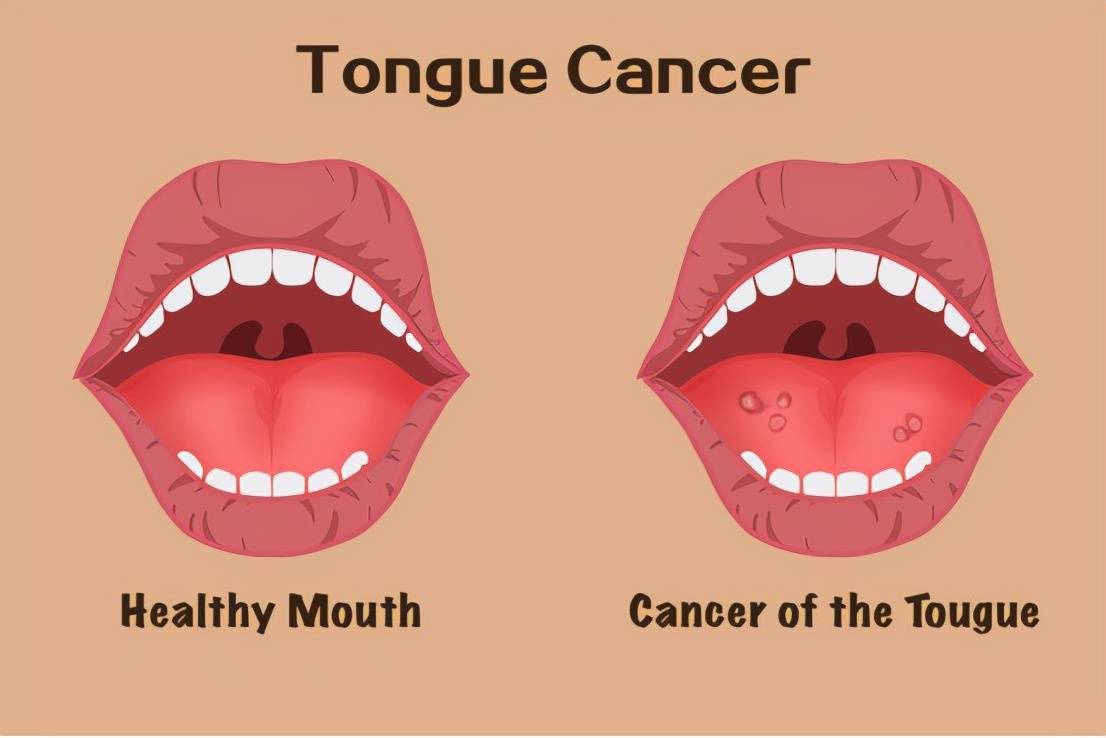 为什么常见的口腔溃疡却会发展为舌癌 发病率 因素 患者