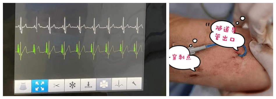集团开展3cg定位下隧道式picc置管技术为重症患者重建生命通道
