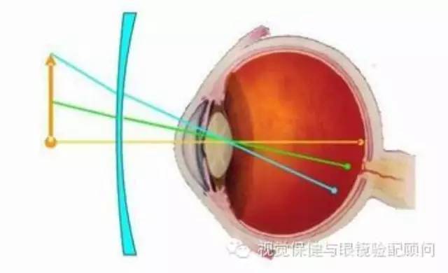 离焦、环焦、全焦镜片,你都了解吗?_周边_屈光度_设计的
