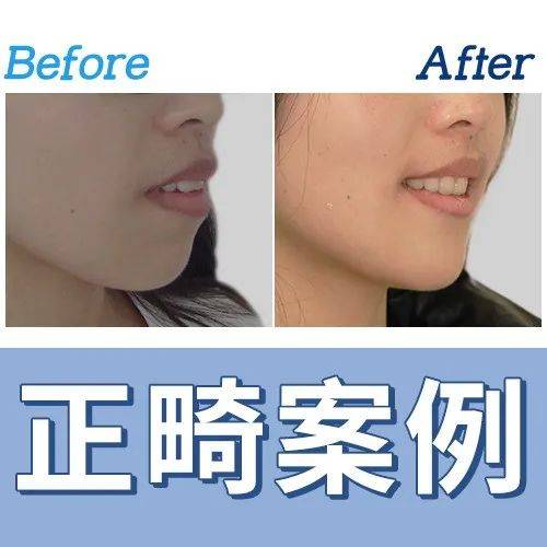 【案例分享】双颌前突、前牙开合、牙列不齐矫正案例_医生_程秀_患者