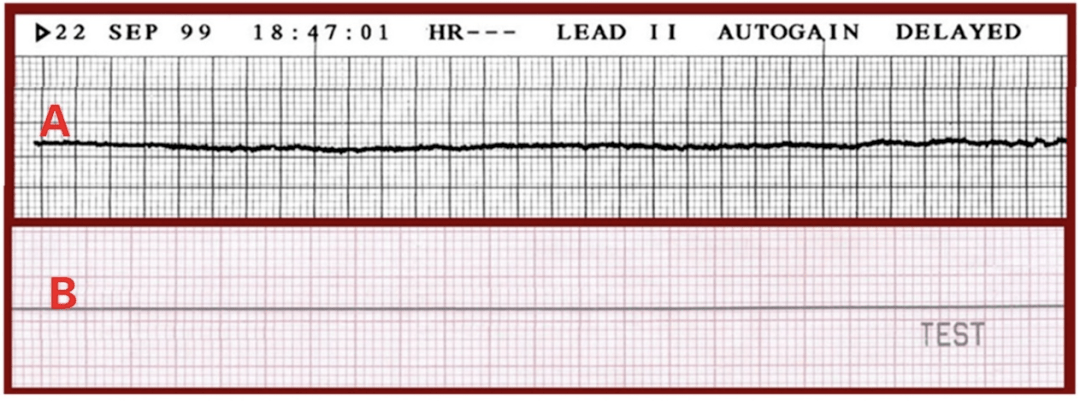 ② 心电图的特征性改变:包括室颤,无脉电活动及心电静止.