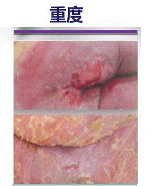 失禁相关性皮炎如何护理?这个方法经济有效!_皮肤_患者_损伤