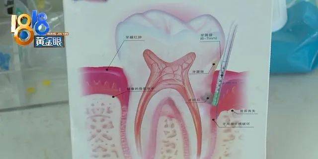 根管治療後斷針,需要告知患者嗎?又該怎麼賠償?_吳女士_醫生_牙齒