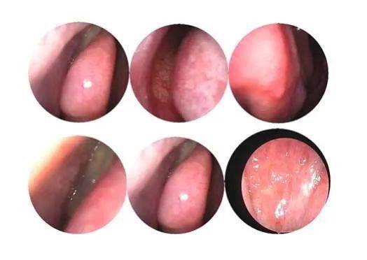 健康提醒快看这是一封来自息肉的认罪书