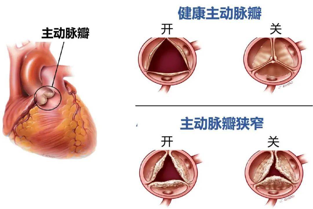 主动脉的三个瓣膜图片图片