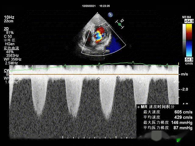 ef:42%,左室舒末内径76,左室心尖部室壁瘤32*26 mm,二尖瓣重度关闭不