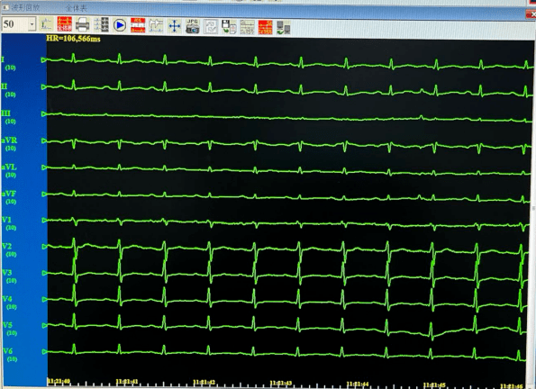 医生将标测导管放入心腔内,进行电生理检查,确认其为房室结折返性心动