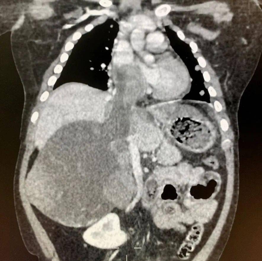 肝脏|【首儿医典】肝母细胞瘤