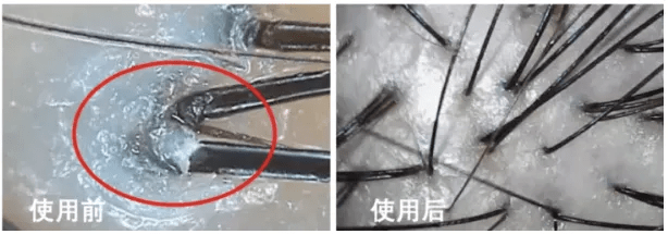 尸体头上抠下来的白泥竟是螨虫尸体!头痒头屑出油多,用它就对了