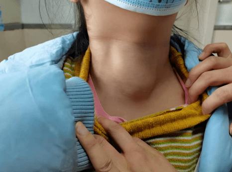 淄博市第一医院乳腺甲状腺外一科成功为一名7岁幼童完成甲状腺手术