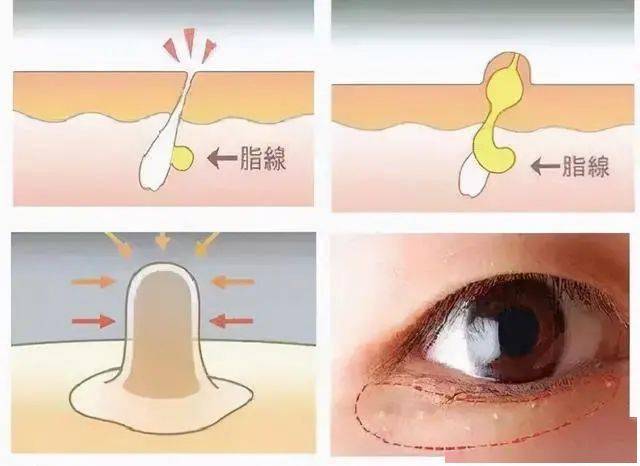 医学长了脂肪粒到底挤不挤?一分钟教你处理它的正确姿势!