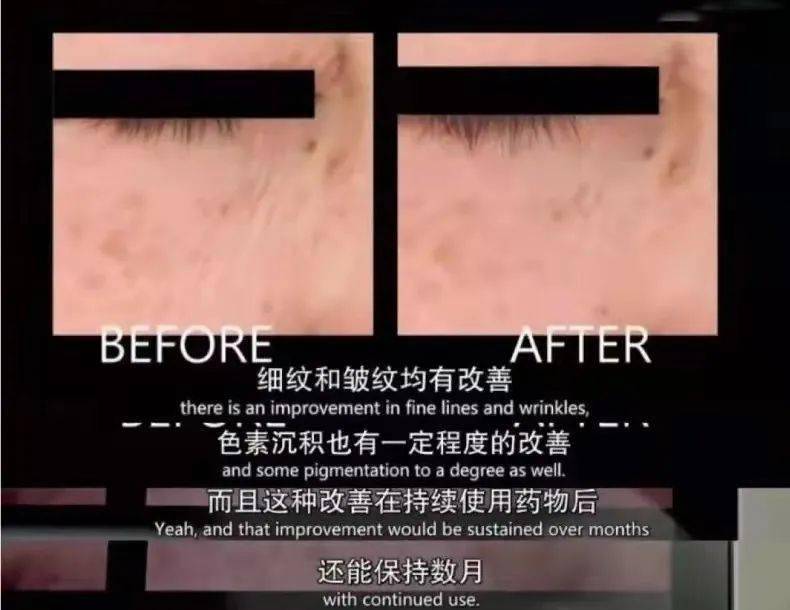 医学长了脂肪粒到底挤不挤?一分钟教你处理它的正确姿势!