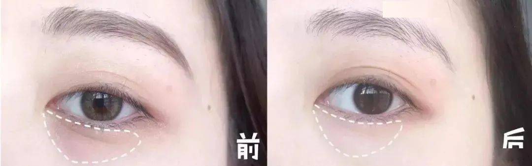 医学长了脂肪粒到底挤不挤?一分钟教你处理它的正确姿势!