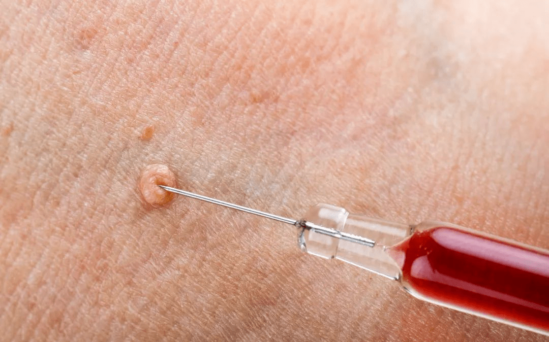 扁平疣会传染吗患上扁平疣后做到4件事不易复发